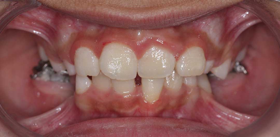 Teeth Braces in Dubai