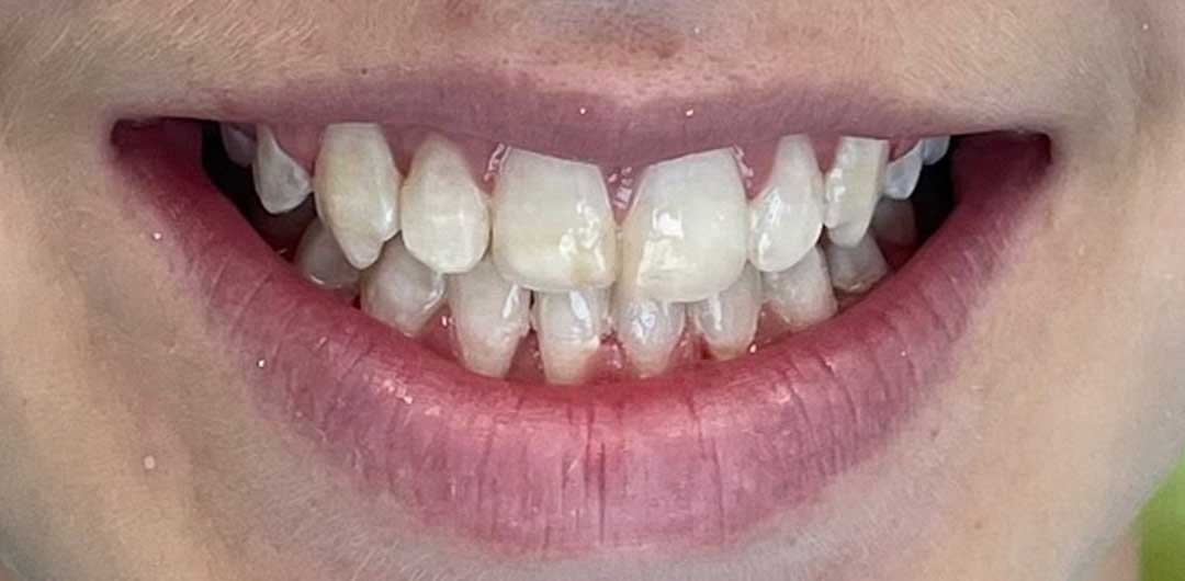 Teeth Braces in Dubai