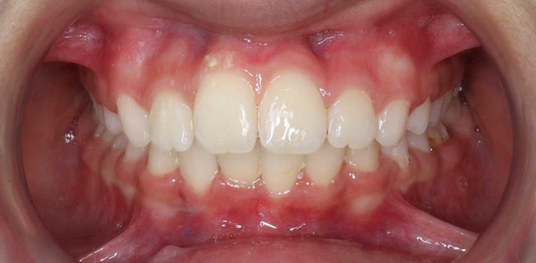 Teeth Braces in Dubai