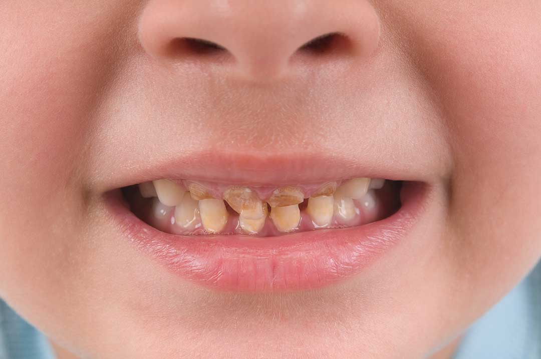 Child's teeth with cavities