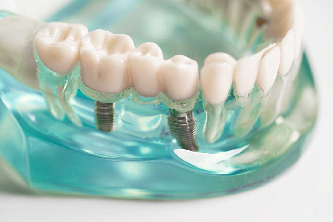 Dental implants mockup