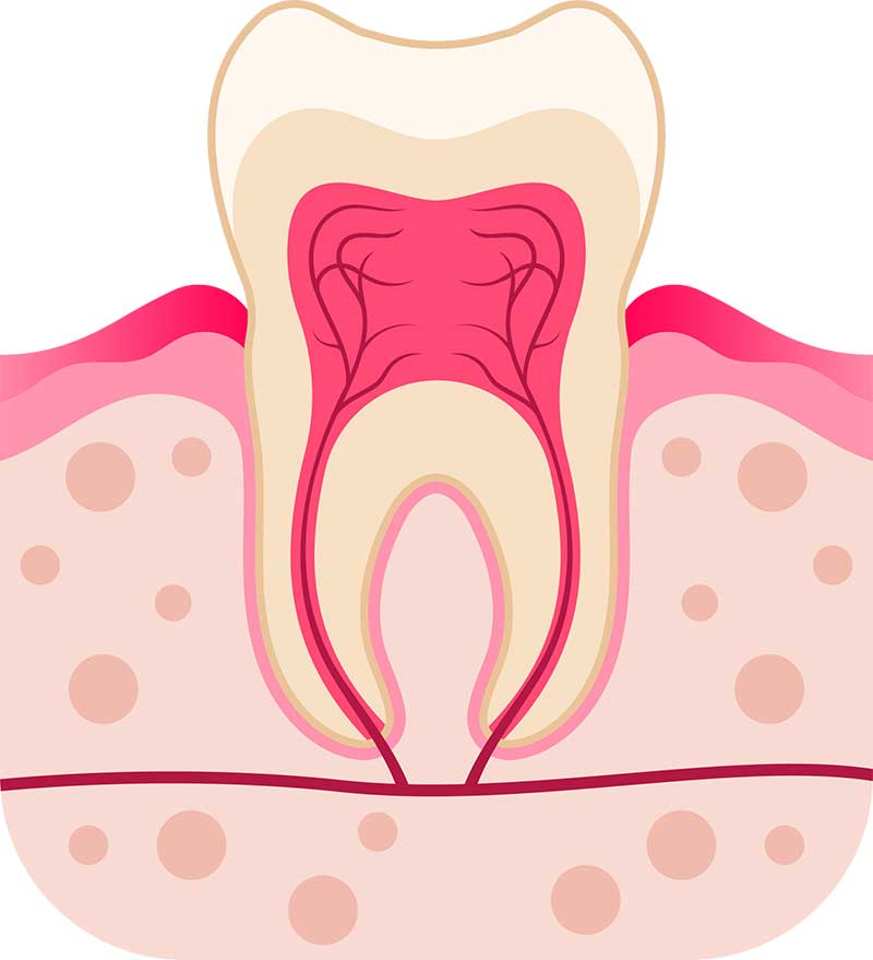 Gingival abscess