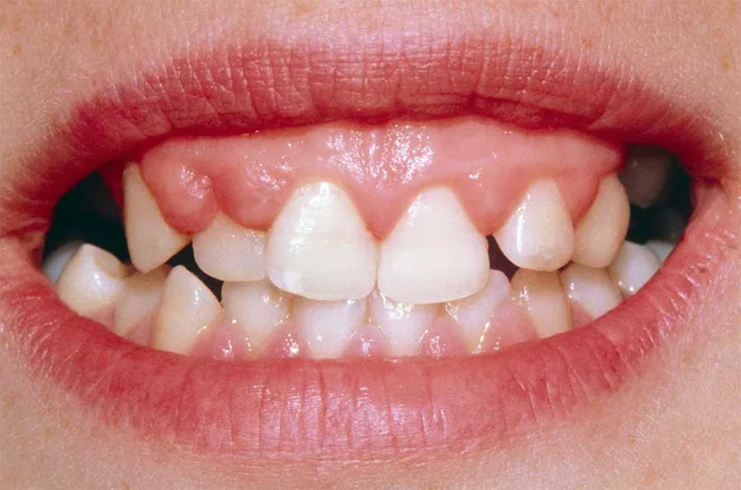 Gingival hyperplasia