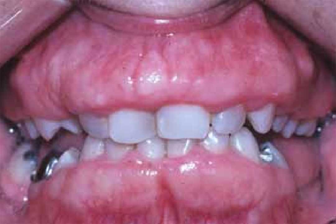 Hereditary gingival fibromatosis