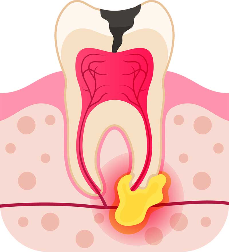 Periapical abscess