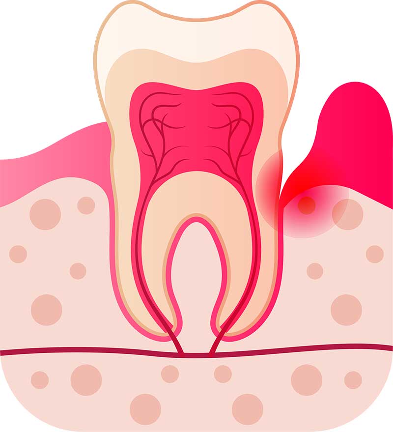 Periodontal abscess