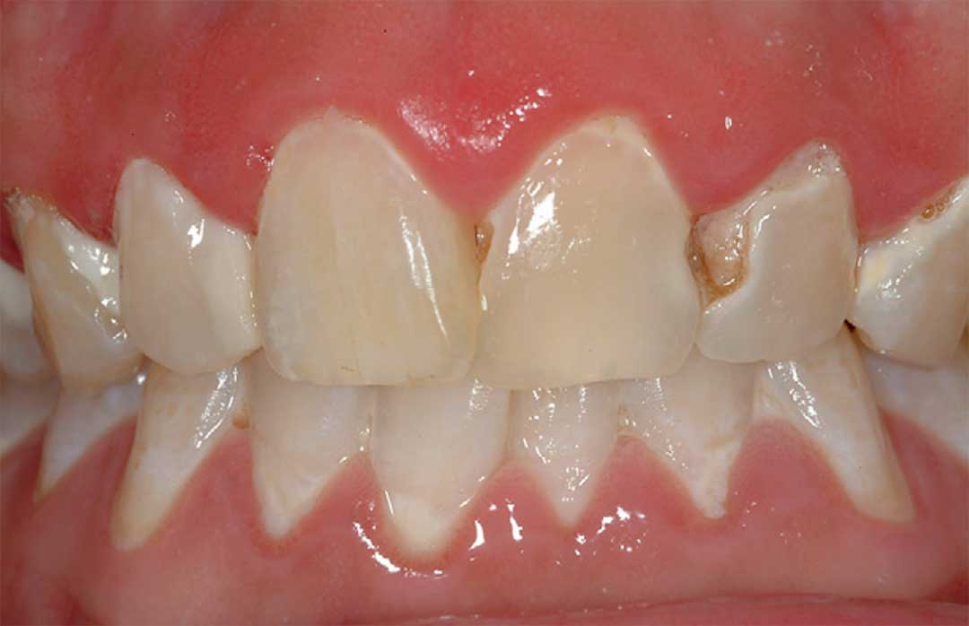 White spots on teeth