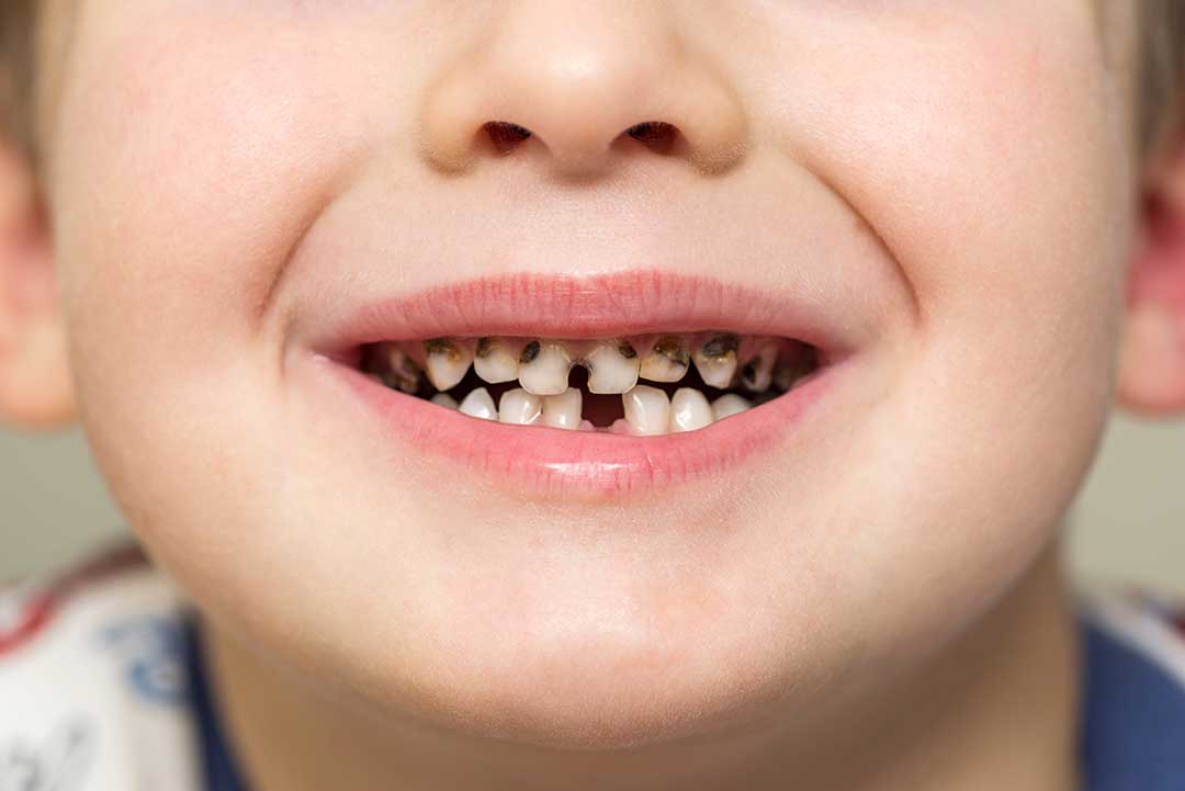 Black spots on child's teeth