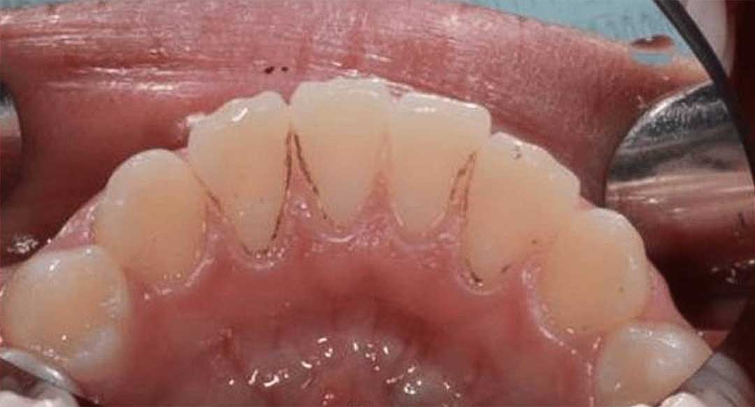 Black spots on child's teeth