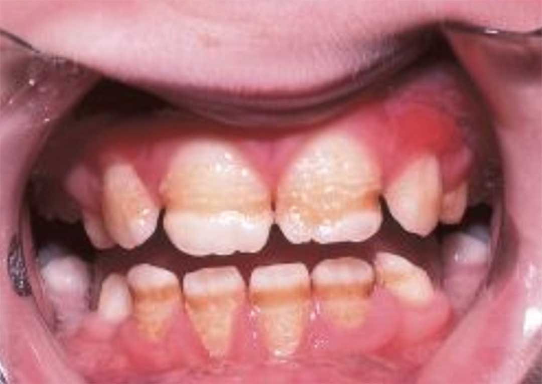 Black spots on child's teeth