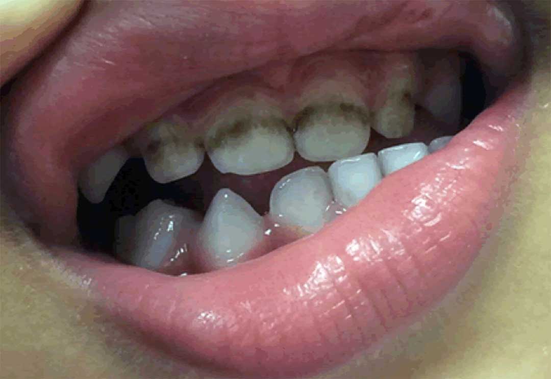 Black spots on child's teeth