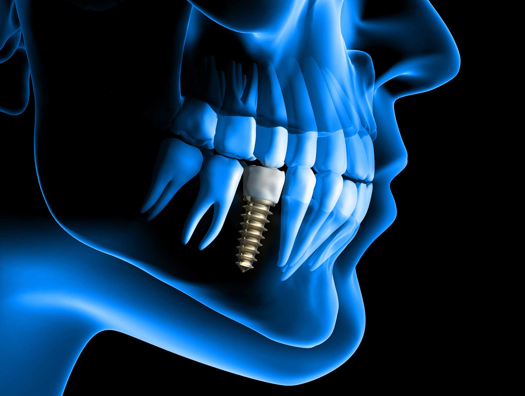 3D Guided Implant Surgery