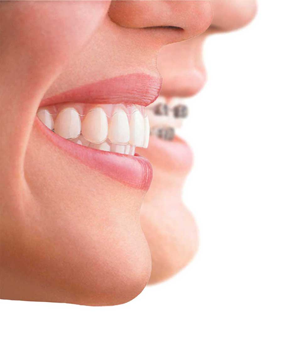 Clear Aligners Dubai