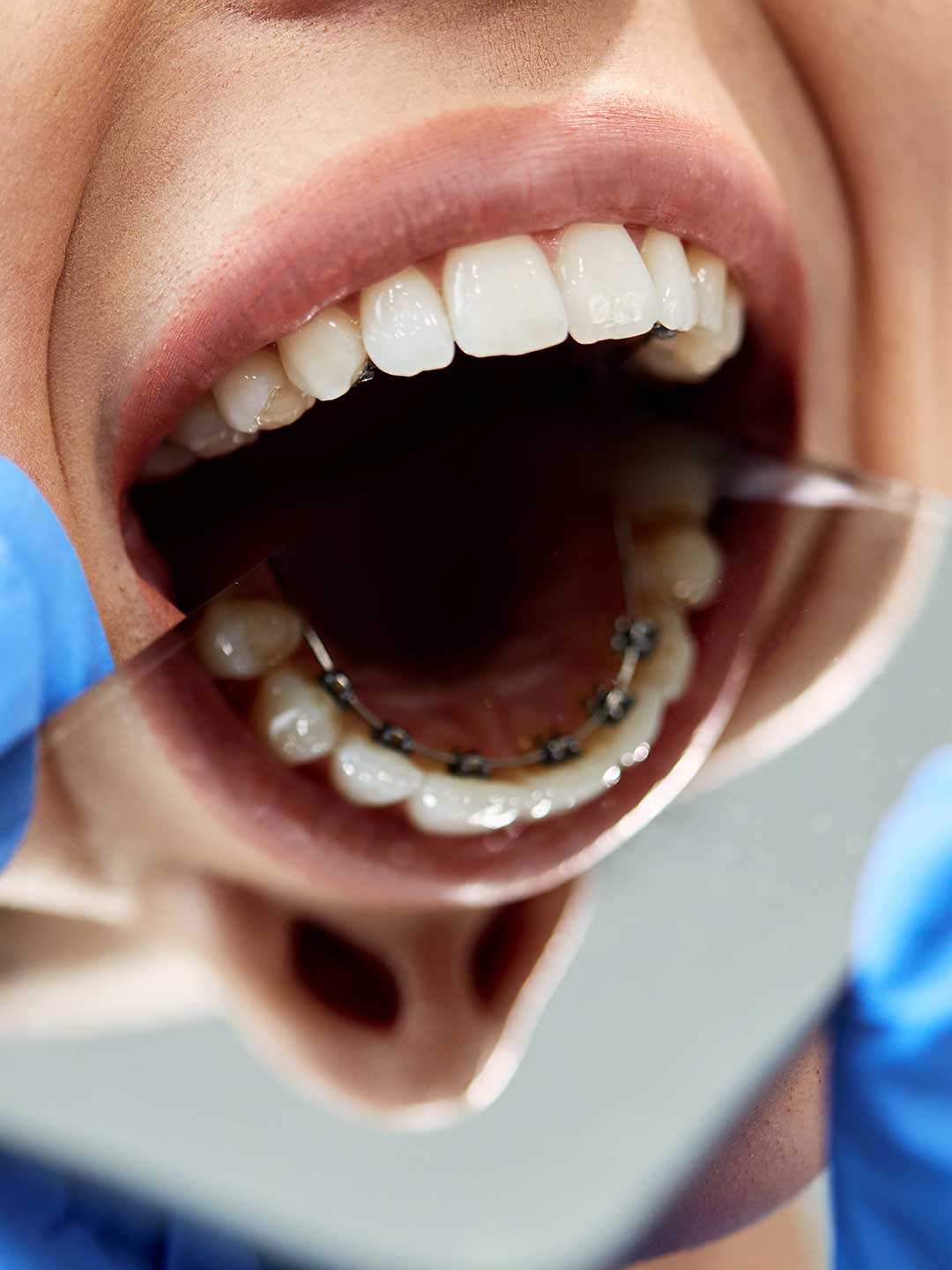 Hidden Braces in Dubai