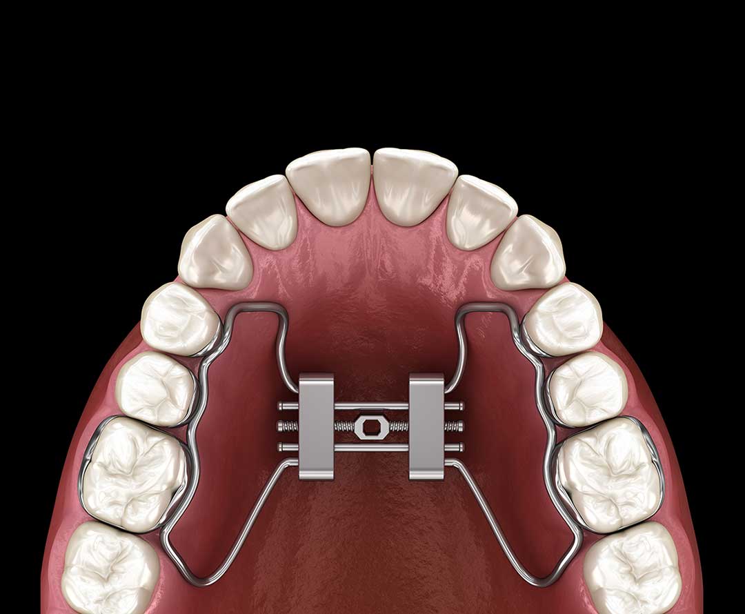 Palate Expander