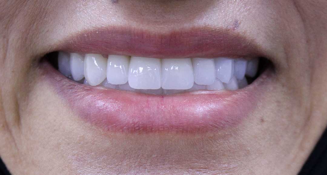 Veneers in Dubai