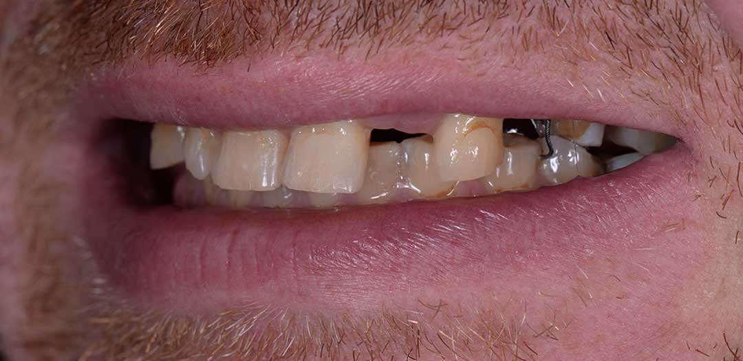 Before full mouth dental implants