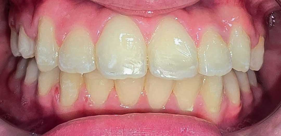 Teeth Braces in Dubai
