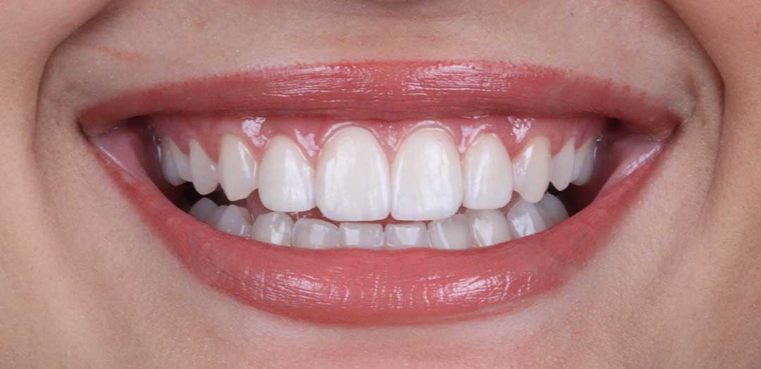 Veneers in Dubai