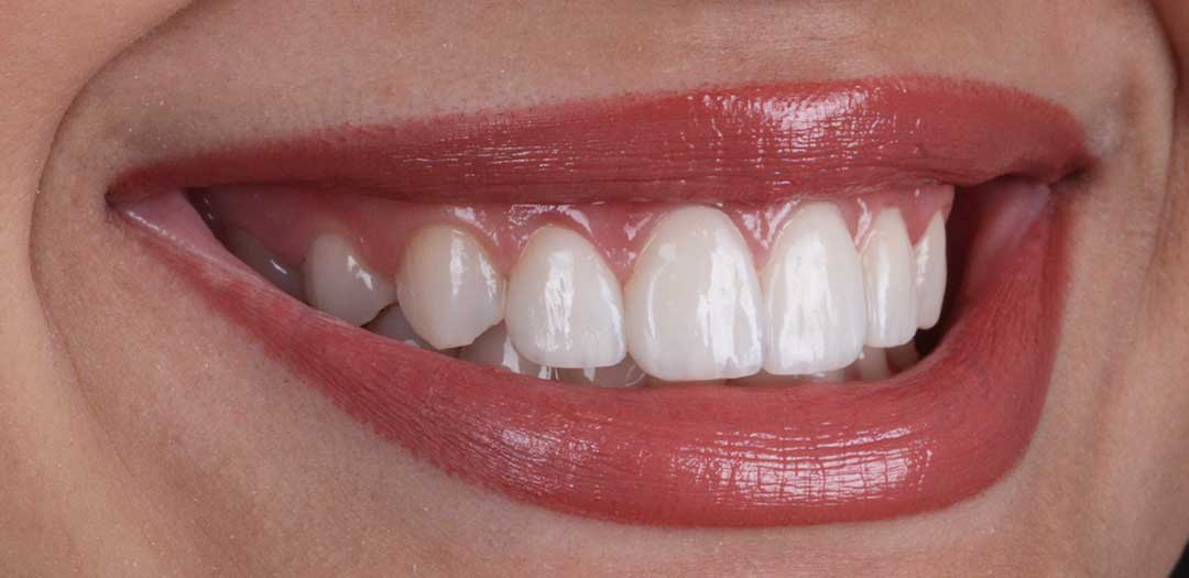 Veneers in Dubai